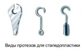 Стапедопластика — операция по восстановлению слуха