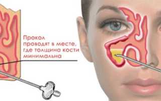 Прокол носовых пазух при синусите