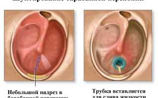 Промывание уха при отите: зачем нужно промывать воспаленные уши