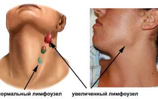 Увеличение лимфоузлов на шее: причины, симптомы, лечение, народные средства