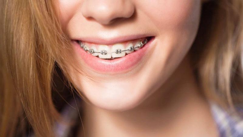 Что собой представляют брекеты American orthodontics Mini Master