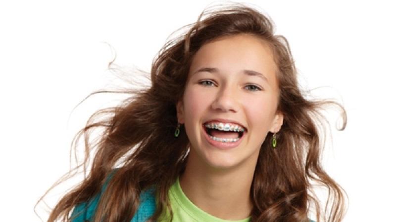 Что собой представляют брекеты American orthodontics Mini Master