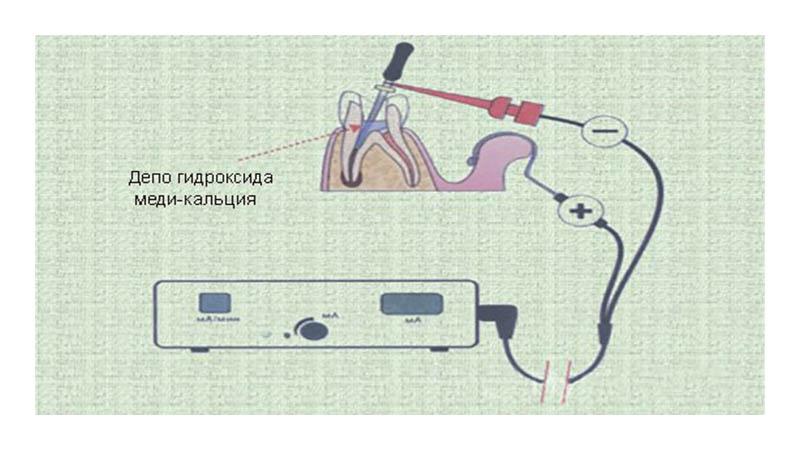 Что такое депофорез и насколько это больно
