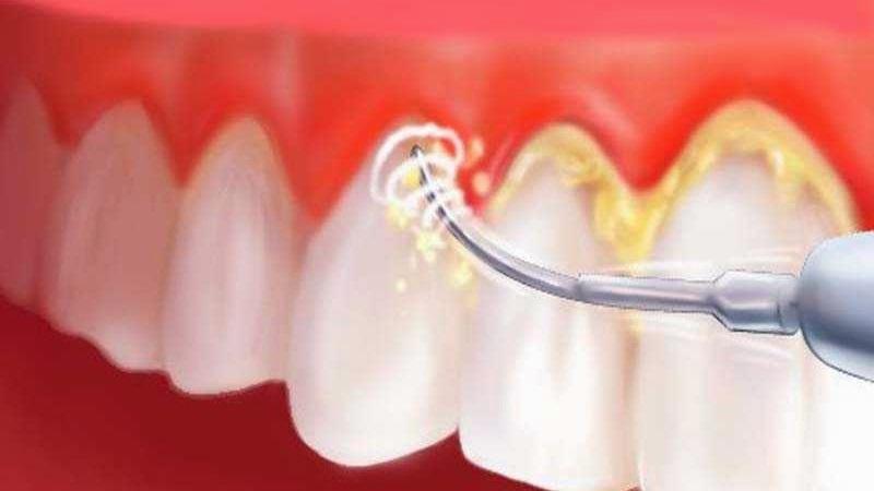 Что такое коагуляция десны