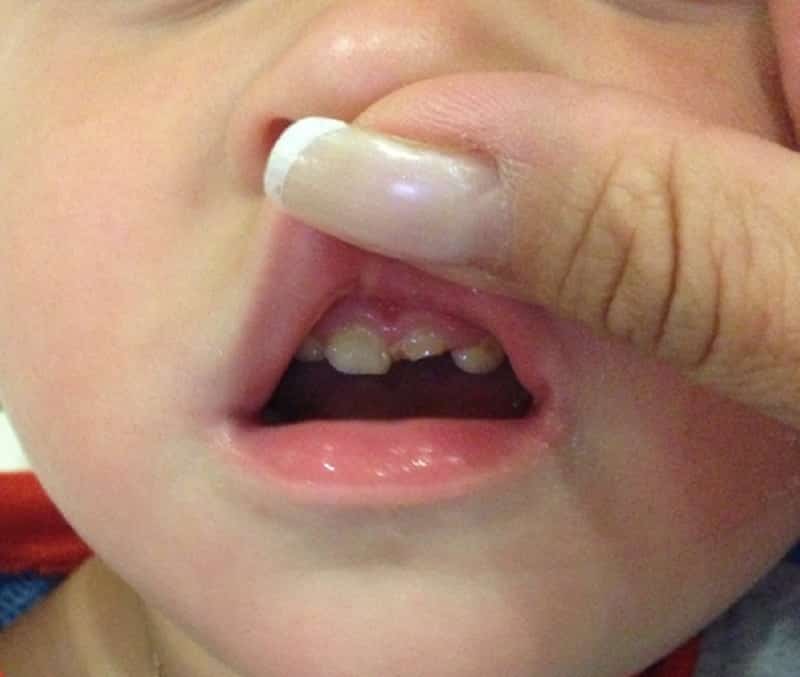 Откололся передний зуб что делать