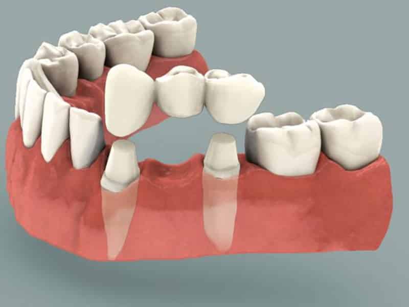 Какие зубы лучше вставить
