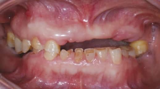 Сильно разрушенные кариесом зубы Сильно разрушенные кариесом зубы