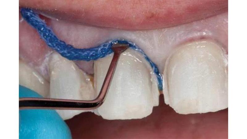 Что такое ретракция десны