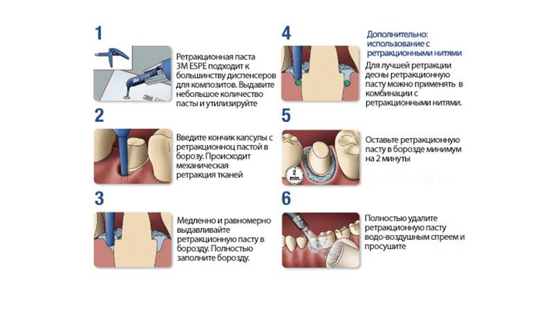 Что такое ретракция десны