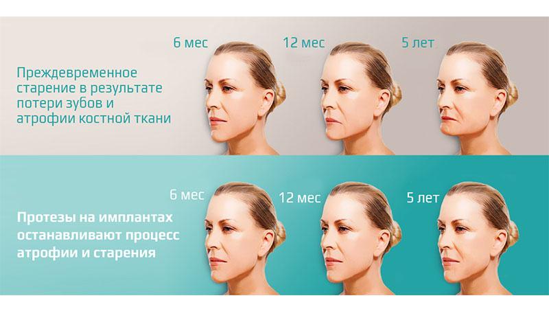 Что такое синус-лифтинг