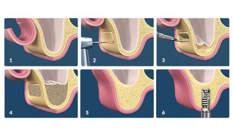 Что такое синус-лифтинг