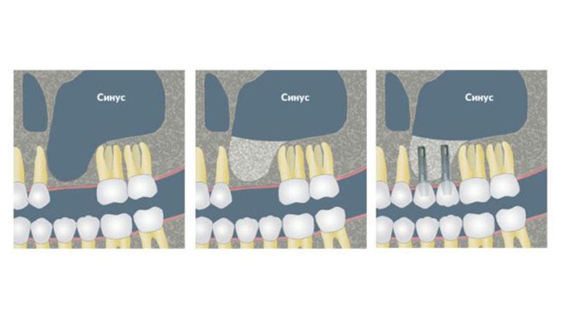 Что такое синус-лифтинг