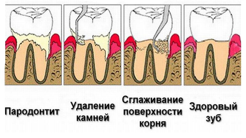 Что такое гингивотомия зуба
