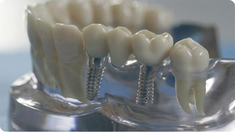 Для чего применяются титановые сетки в стоматологии