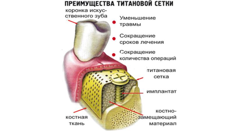 Для чего применяются титановые сетки в стоматологии