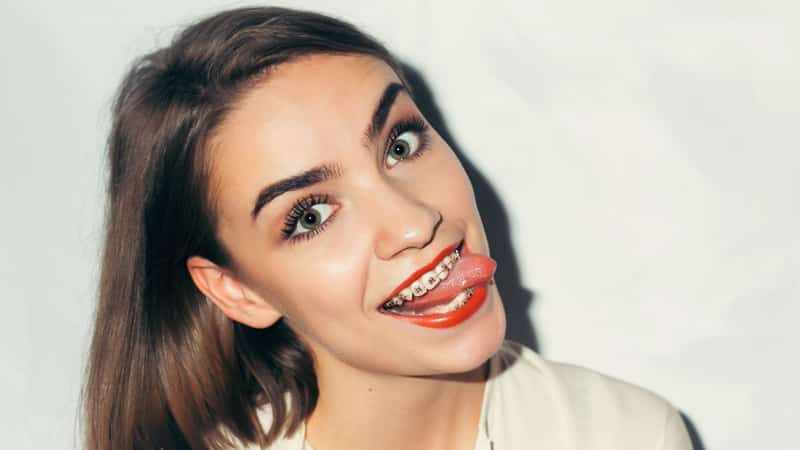 Самолигирующие брекеты что это такое