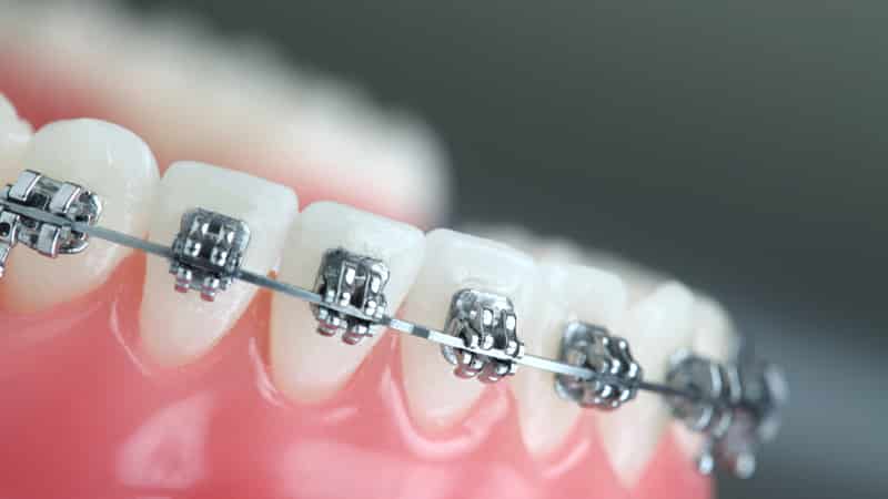 Металлические самолигирующие брекеты