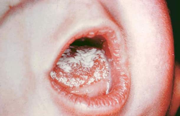 Фото1. Кандидозный стоматит Фото1. Кандидозный стоматит