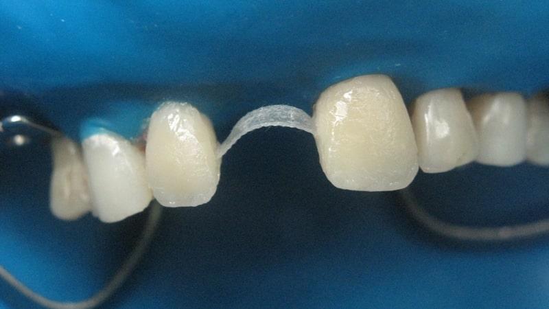 адгезивный мостовидный протез фото