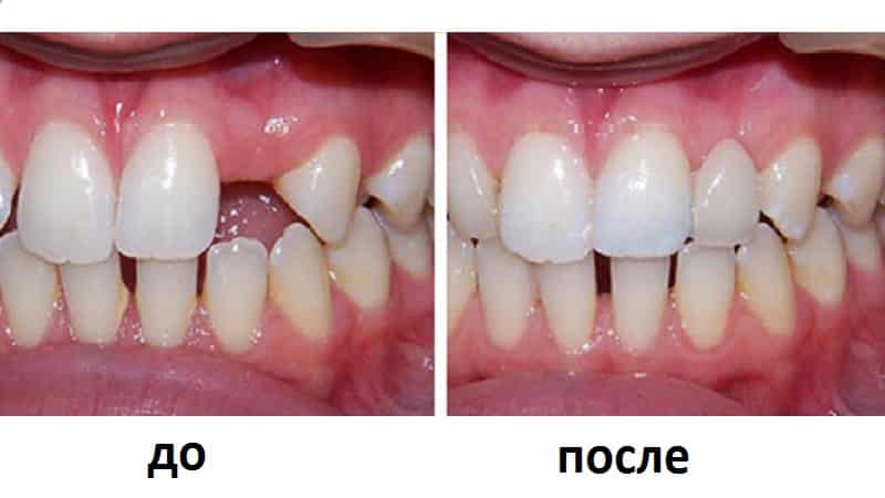 адгезивное протезирование зубов