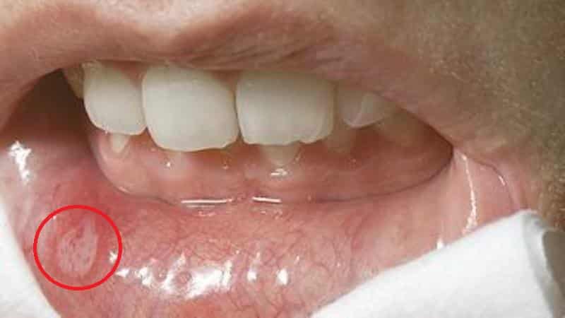 афтозный стоматит лечение у взрослых фото