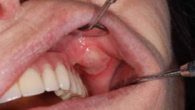 афтозный стоматит фото