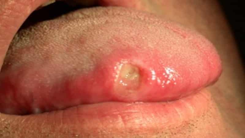 лечение афтозного стоматита у взрослых