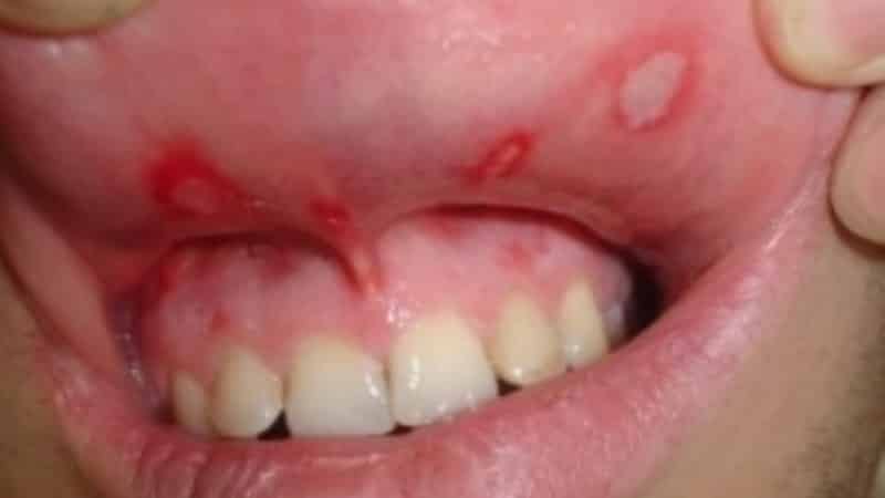 лечение афтозного стоматита у детей