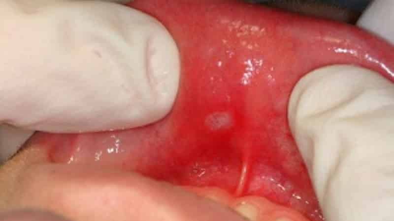 афтозный стоматит у ребенка лечение