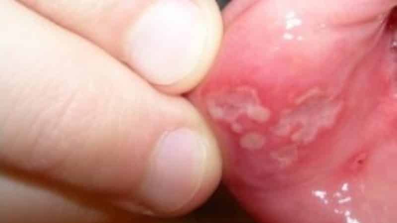 чем и как лечить афтозный стоматит у детей