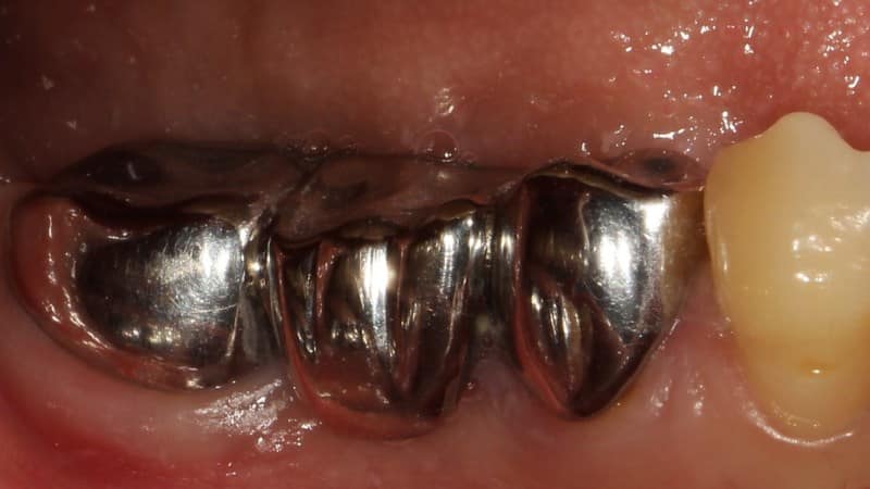 аллергия на металлические коронки симптомы