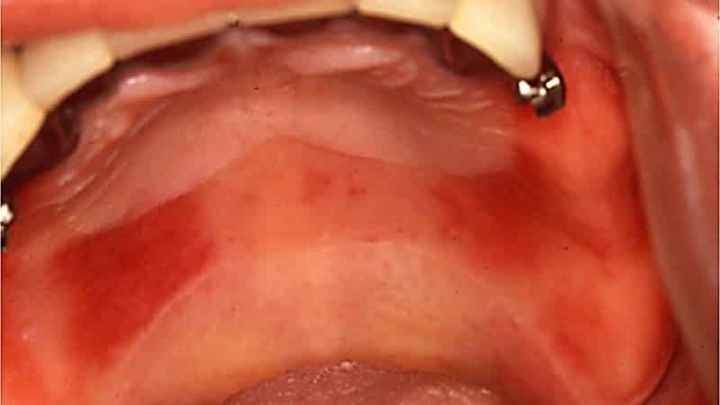 аллергия на металлокерамические коронки симптомы