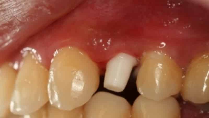 аллергия на зубные протезы симптомы и лечение