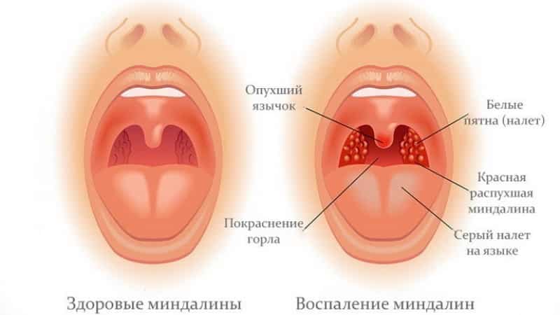 антибиотики при тонзиллите у взрослых