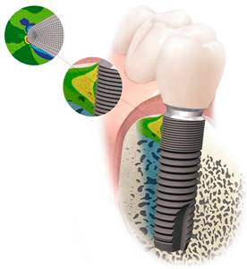 Зубные имплантаты Астра Тек и высокая квалификация наших врачей – ваша идеальная улыбка на долгие годы