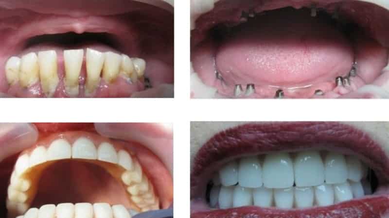 базальная имплантация что это такое