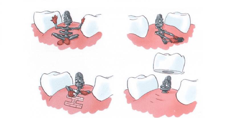 базальная имплантация минусы