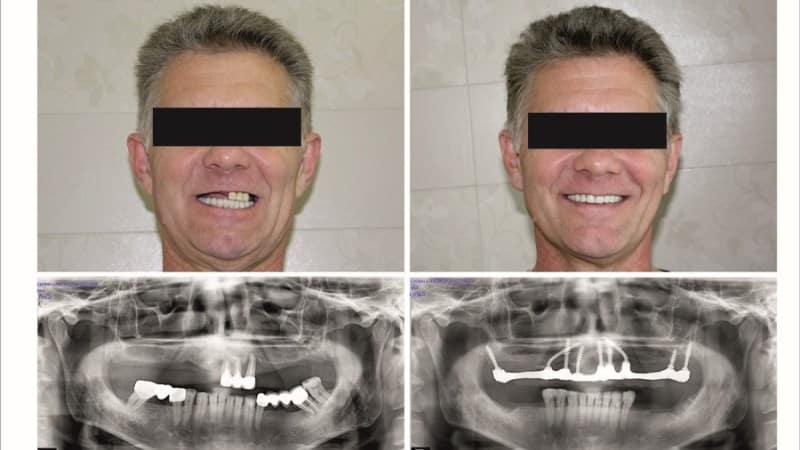что такое базальная имплантация зубов