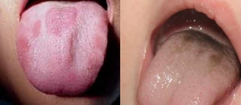 белые пятна точки на языке у ребенка грудничка