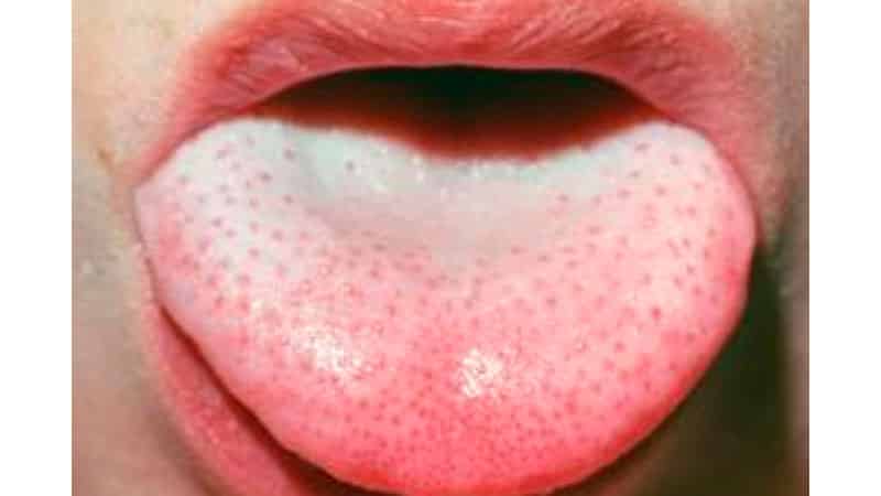 Белый налет у ребенка на языке