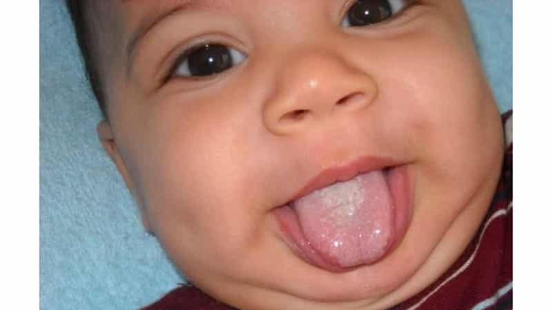 появление белого налета на языке у малыша