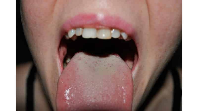 Белый налет на языке