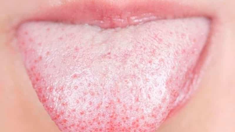 Белый налет на языке