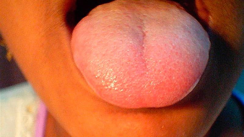 Белый налет на языке