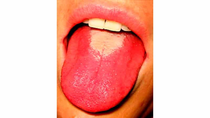 Белый налет на языке у взрослого