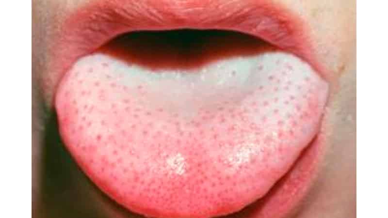 Белый налет на языке у взрослого