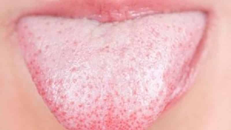 Белый налет на языке