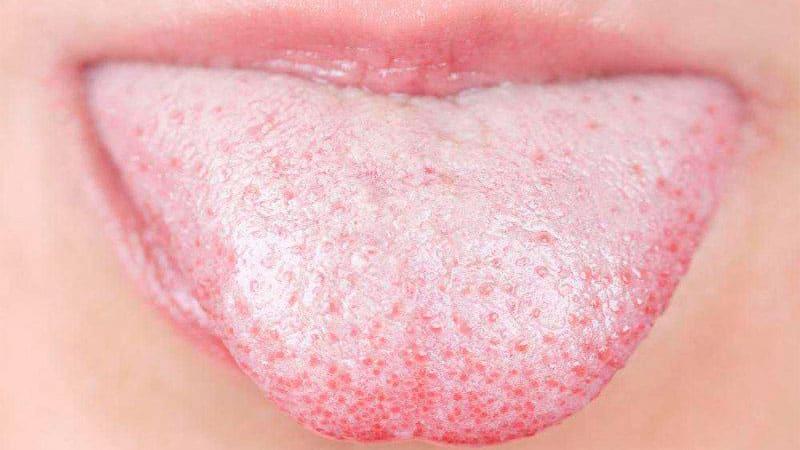 Белый налет на языке у взрослого