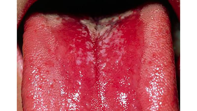 Белый налет на языке