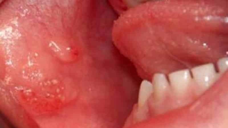 белые прыщики во рту у грудничка